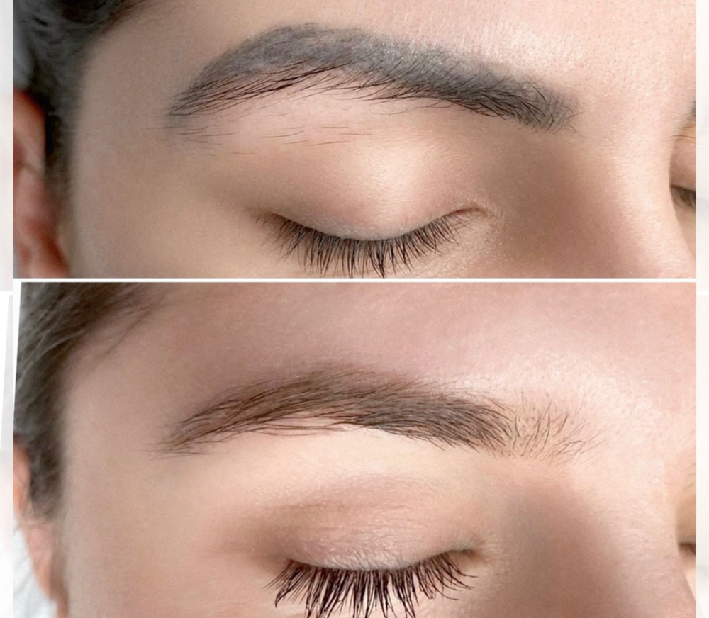 Permanent Eyebrow Tattoo Removal