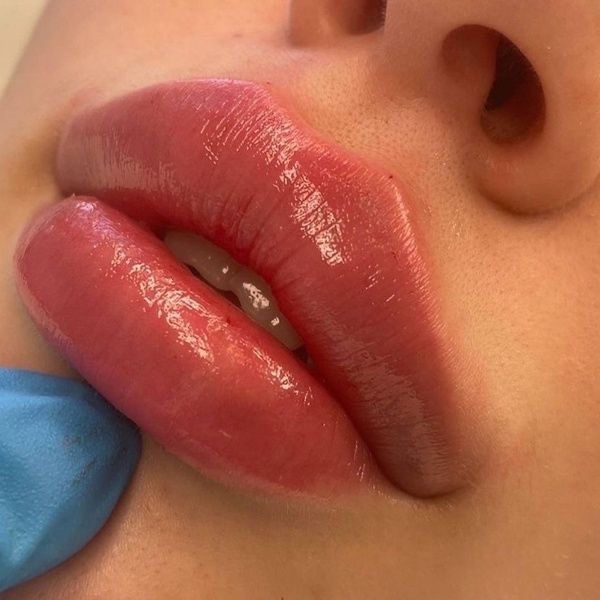 2 ML Lip Fillers