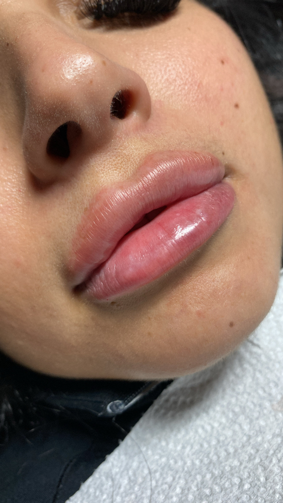 1.1ml MICRONeedle Lip Fillers!