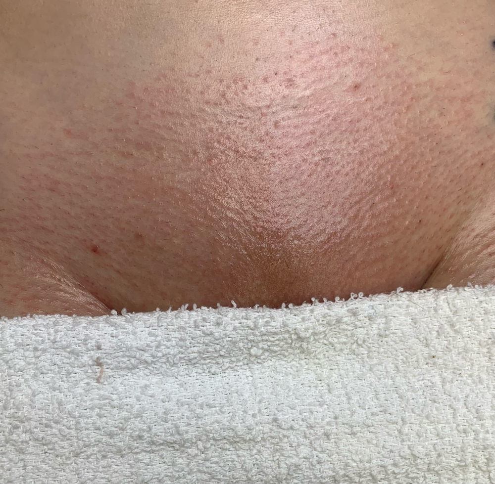 Brazilian Waxing