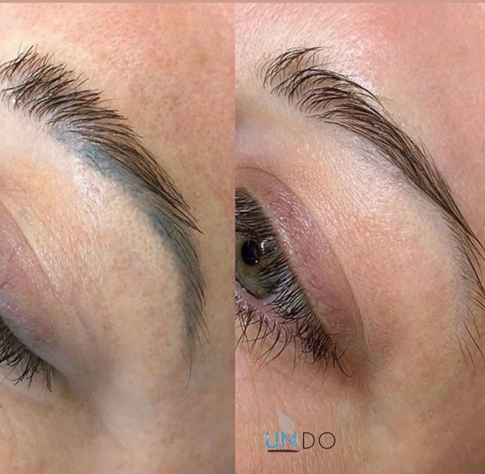 UNDO Non-Laser Tattoo Removal