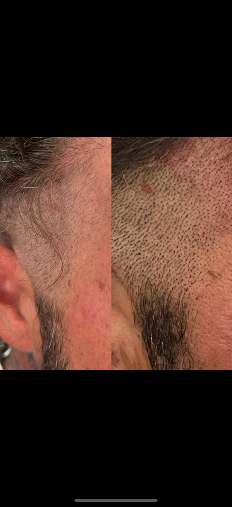 Scalp, Micro pigmentation at Devi Studio in Surprise, AZ