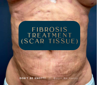 Fibrosis (Scar Tissue) Treatment