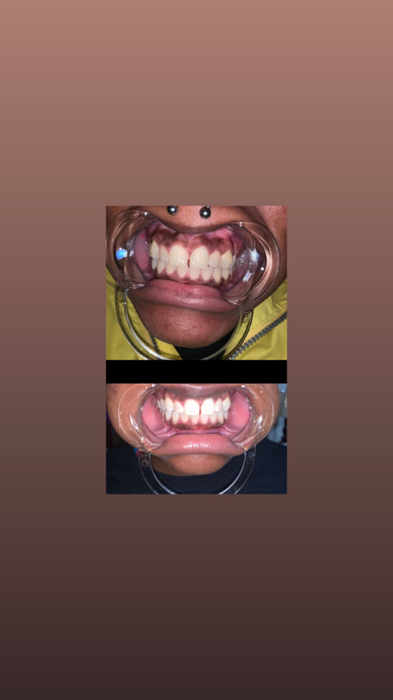 teeth whitening 1hr 30mins at RJ Cosmetics in PONTOTOC, MS