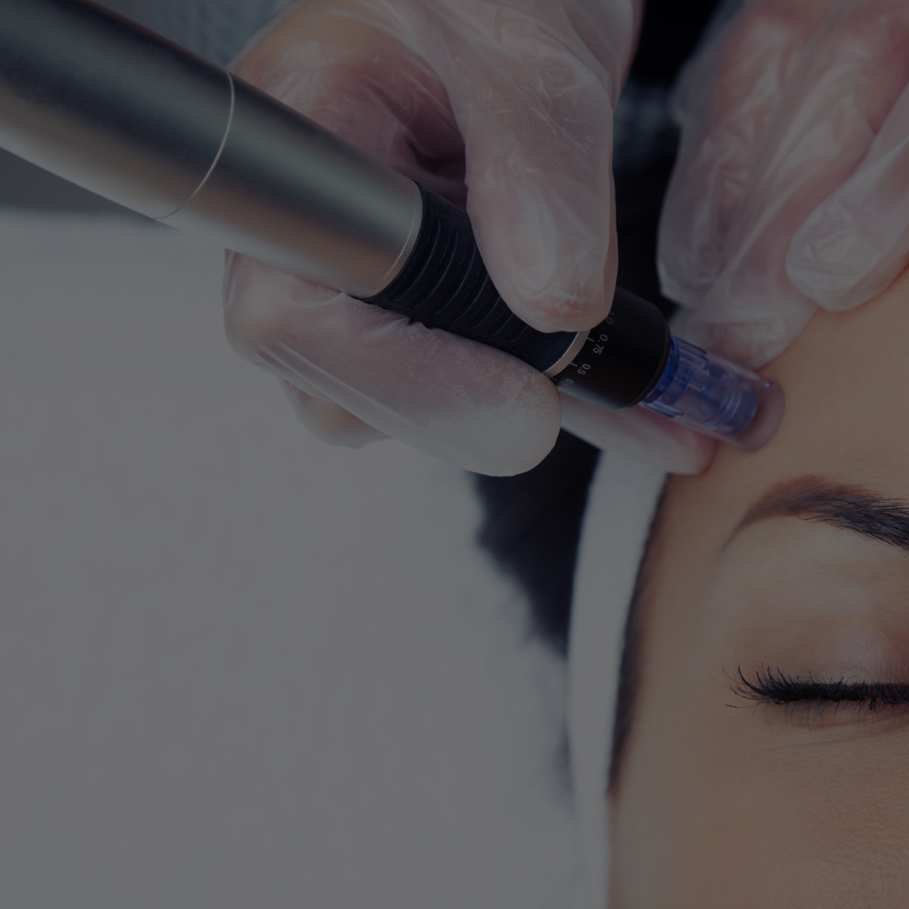Microneedling Radiance
