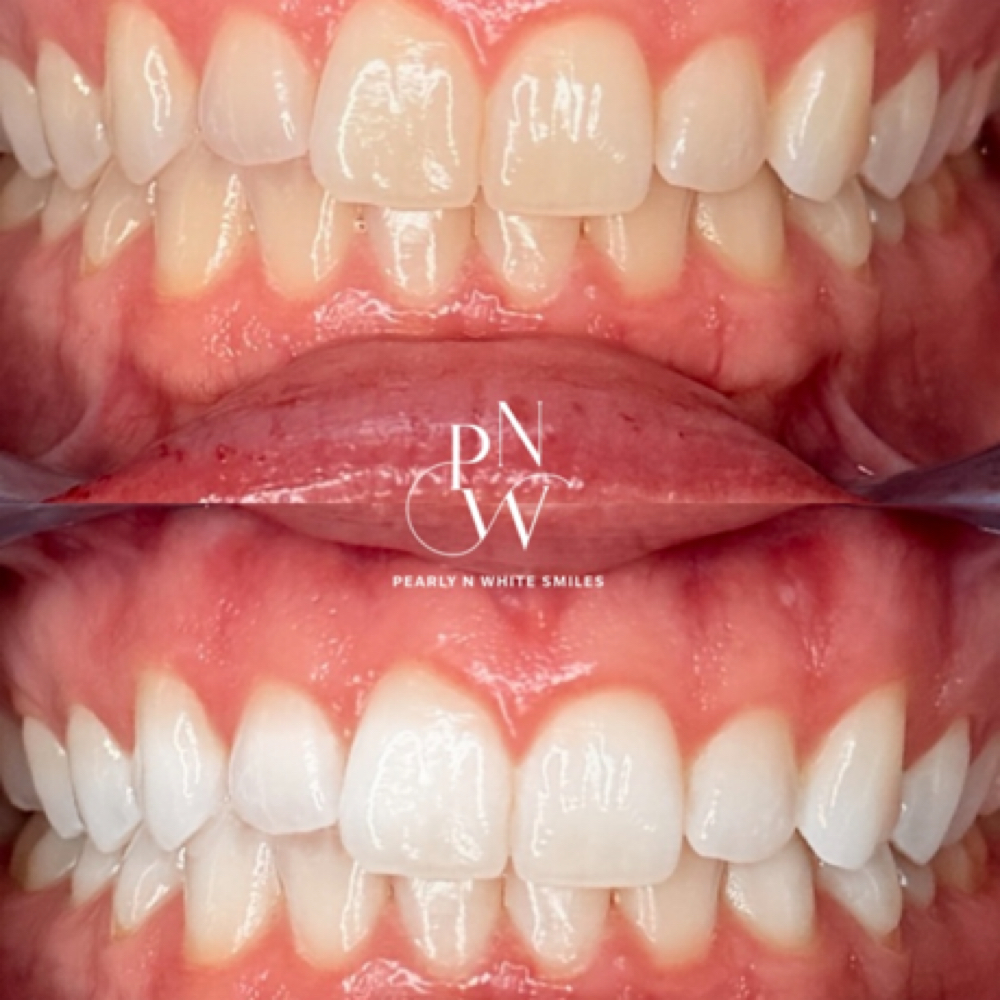 Spring Brightening Special 🌸 at Pearly N White Smiles in Salem, OR