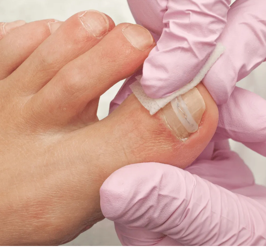 Ingrown Nail Correction Patch