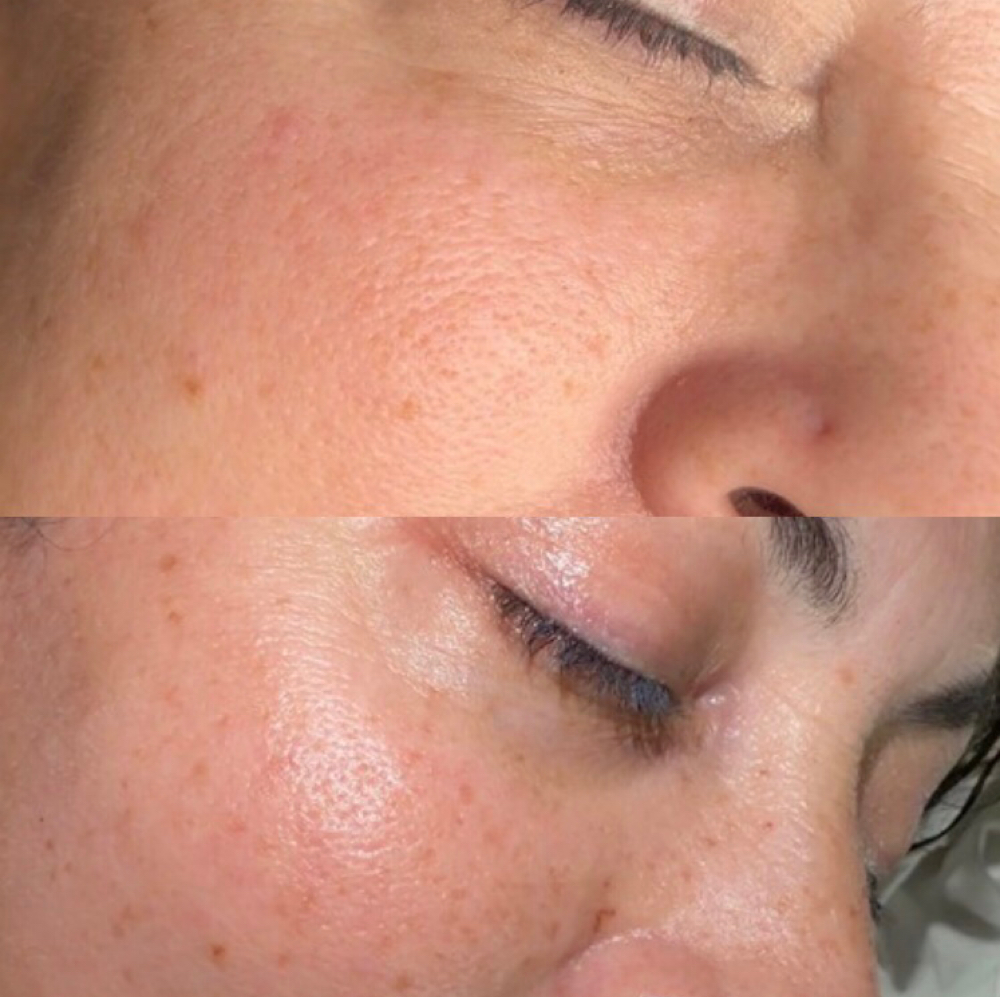 Light To Medium Coverage Freckles at Beauty Ink Studio in Corpus Christi, TX