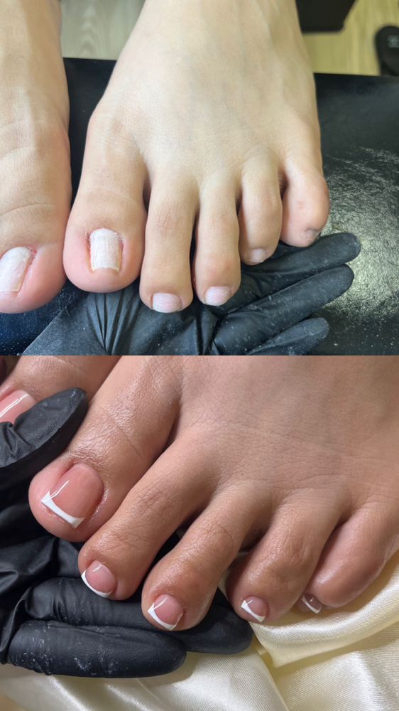 Acrylic Pedicure Toe Reconstruction