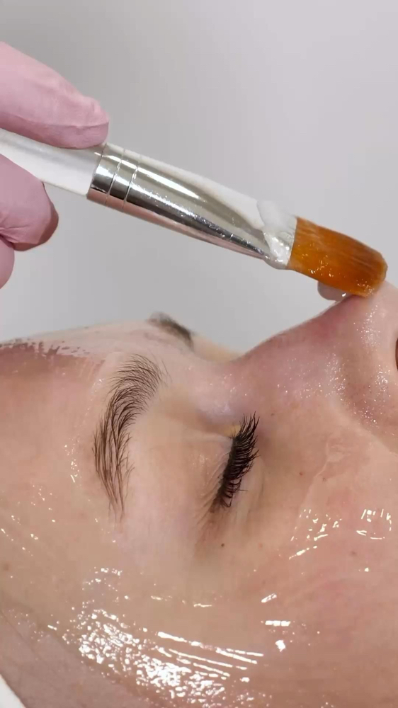 Level 1 Chemical Peel