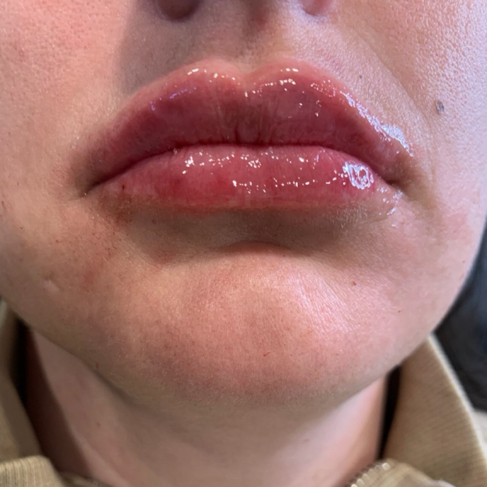Lip Flip at Chacing Beauty in Dayton, OH