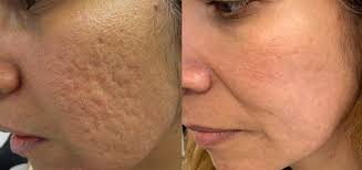 Skin collagen Booster Microneedling