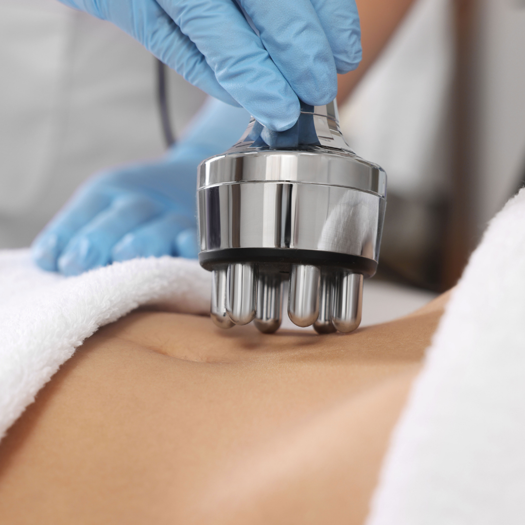 Skin Tightening RF Session