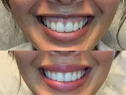 Botox Lip Flip + Lip Filler