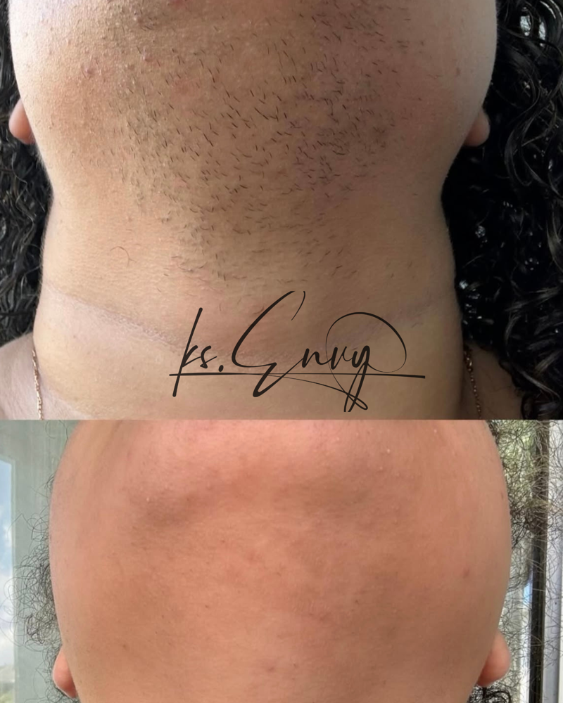 Face: Chin at KS.Envy in Columbus, OH