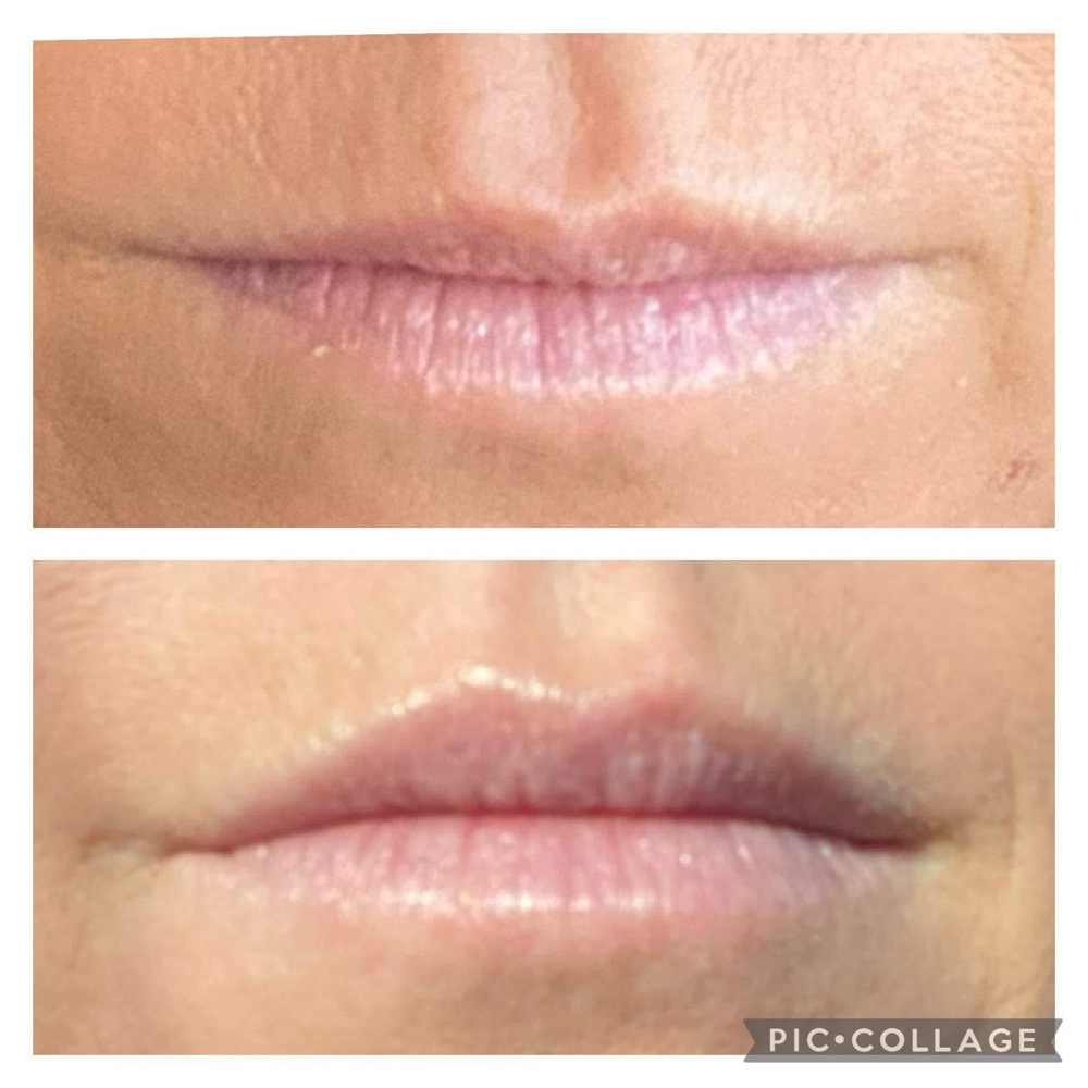 Lip Flip at Elevate Skin Lab in Desloge, MO