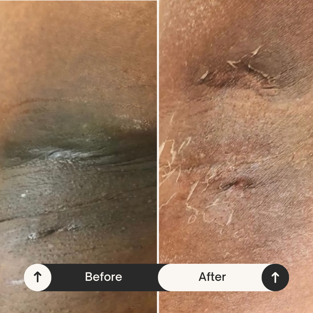 Mens Intimate Bleaching
