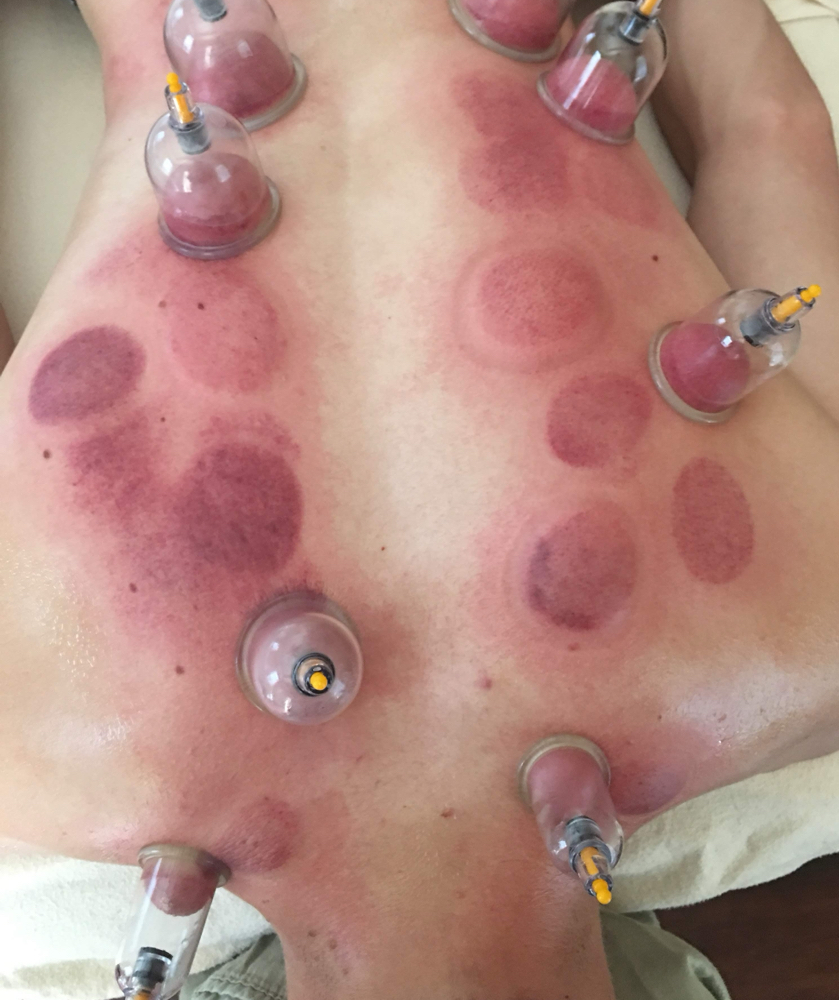 Cupping Therapy