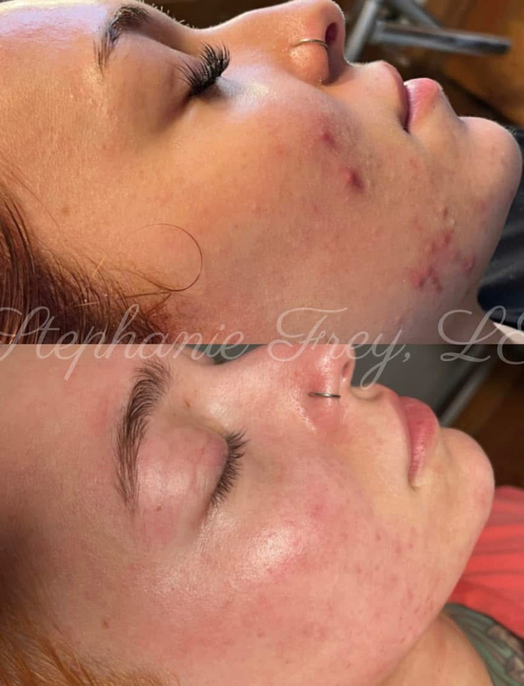 Enzyme Oxygen Rx Treatment