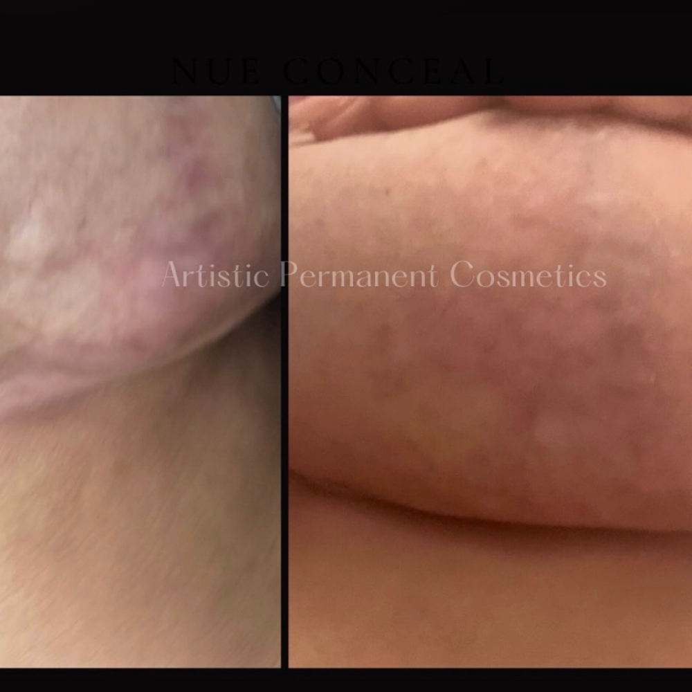 Two Areas Scar/Stretchmark Camo at Artistic Permanent Cosmetics, Karen Alford NPI #1932956950 in Little Rock, AR