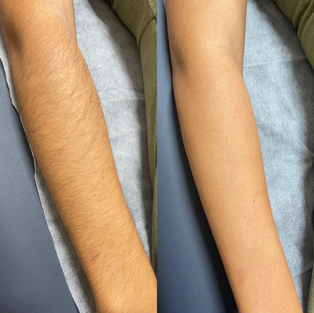 Half Arm Sugaring (Lower Or Upper)
