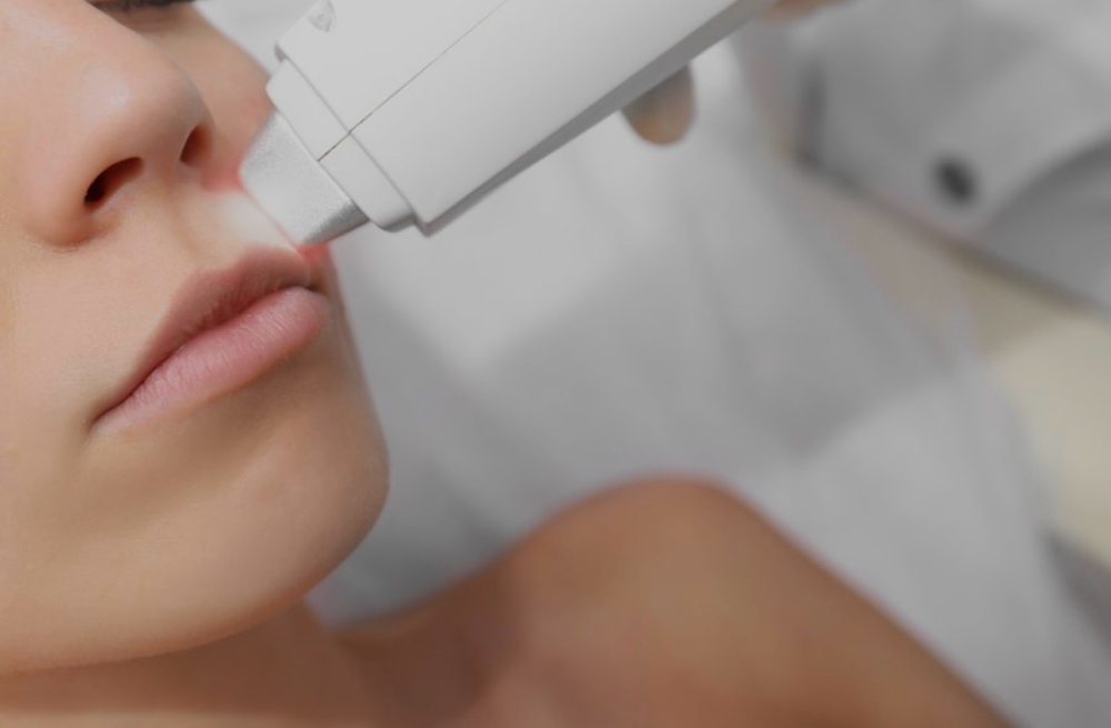 Lip Laser Hair removal (single)