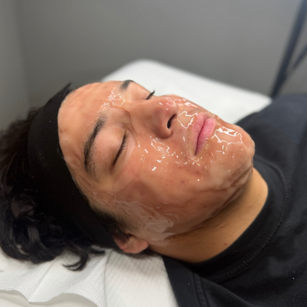 CO2/ Microneedling (Face Only) at Deluxe Beauty Bar in Orem, UT