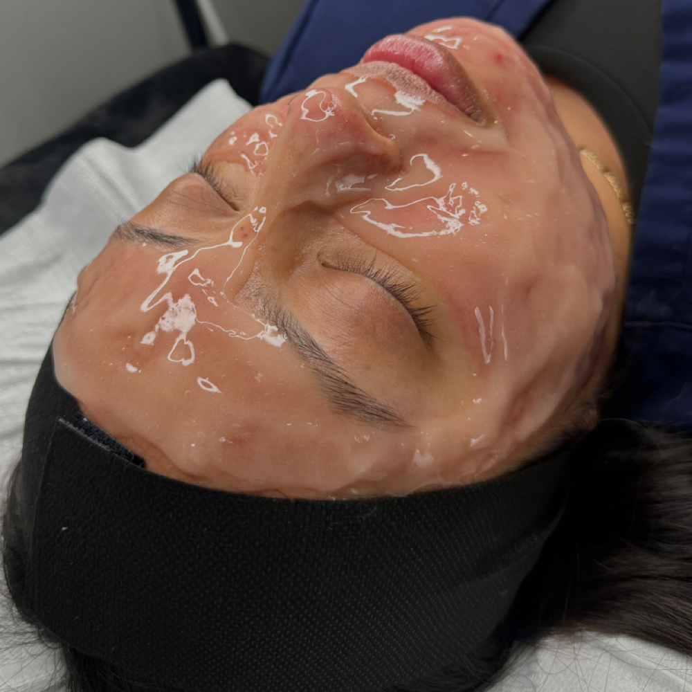 CO2 Lift/ Microneedling (Face Only) at Deluxe Beauty Bar in Orem, UT