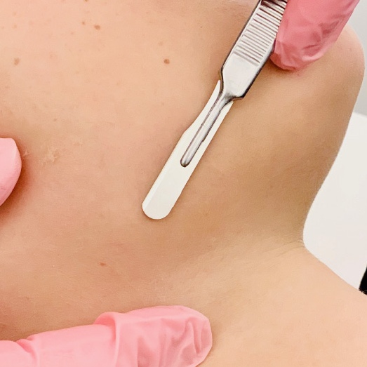Dermaplaning Facial at Brinley Campbell in Jasper, AL