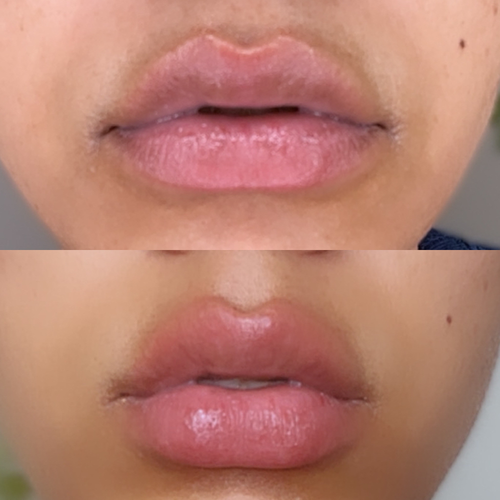 Lip Filler 1ml