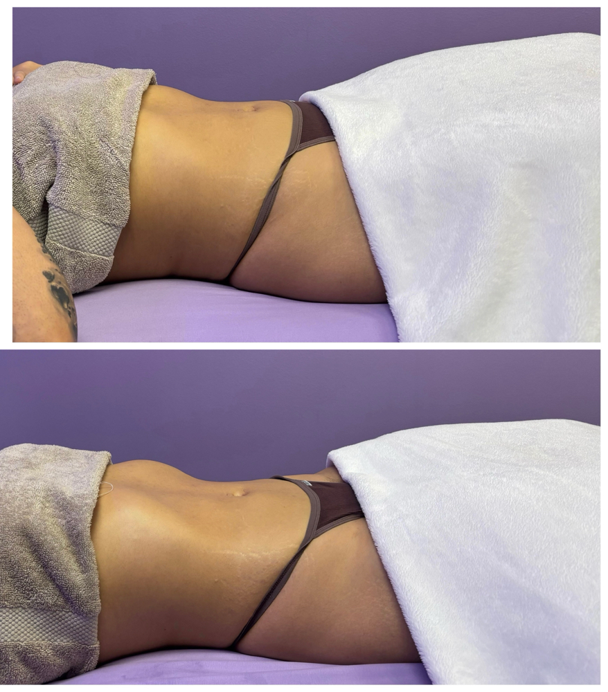 Brazilian Lymphatic Drainage at Divinity Essence Spa in Winter Springs, FL