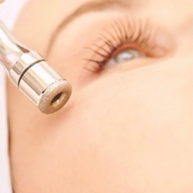Microdermabrasion | Add-on at Vice Kingz Esthetics in Murrieta, CA