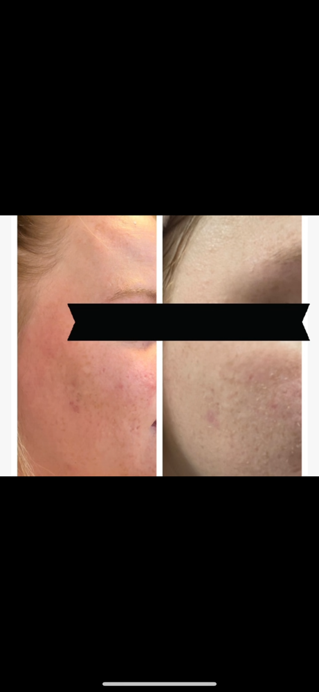 Chemical peel max 8 layers