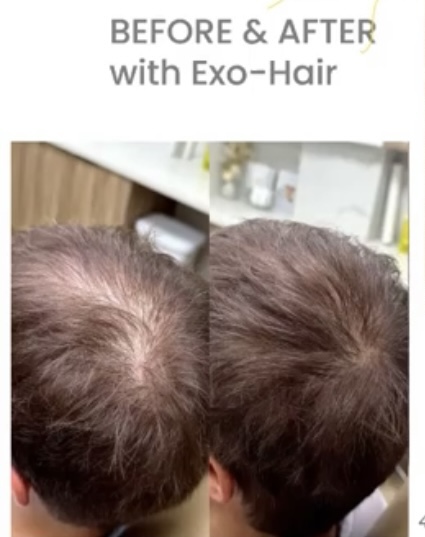 Hair Loss/ Perdida De Cabello