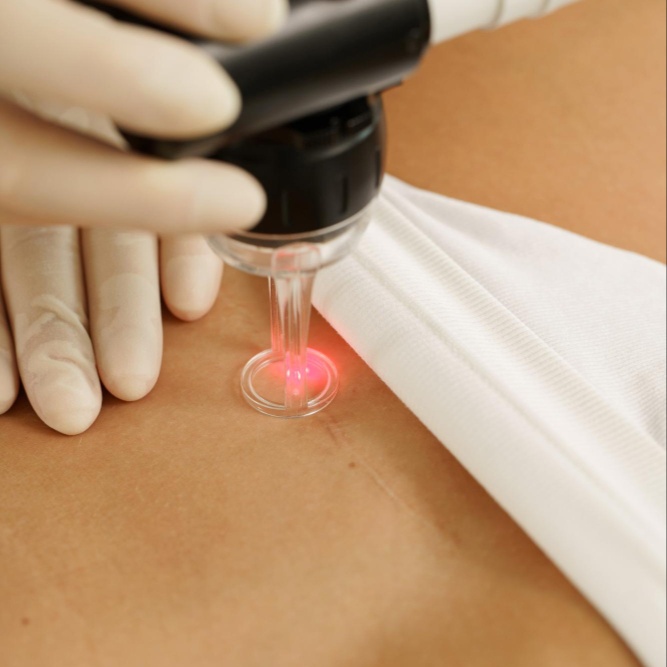 Scar - Medium scars at Finer Beauty Spa in Bronx, NY