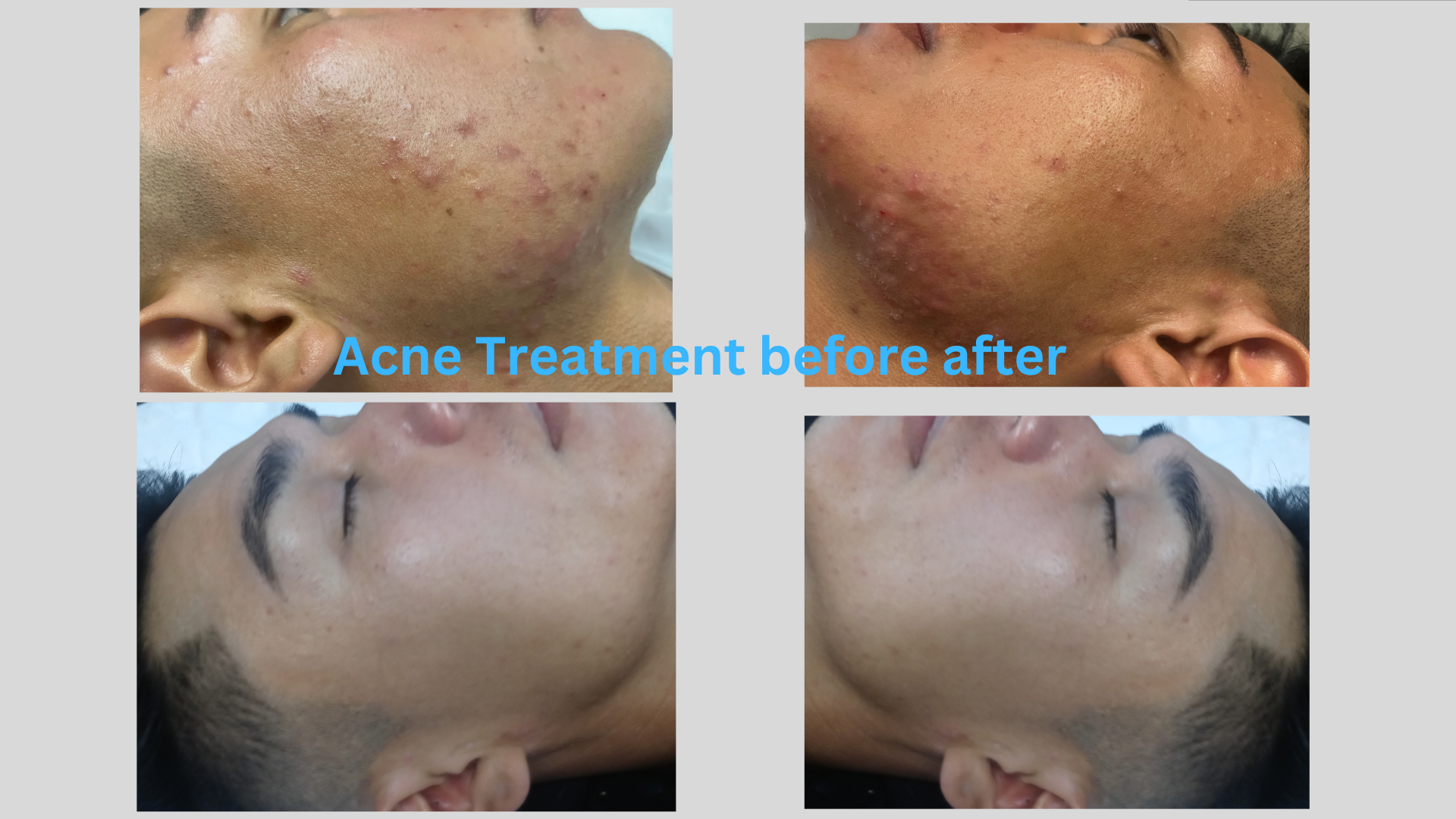 Facial Acne Treatments