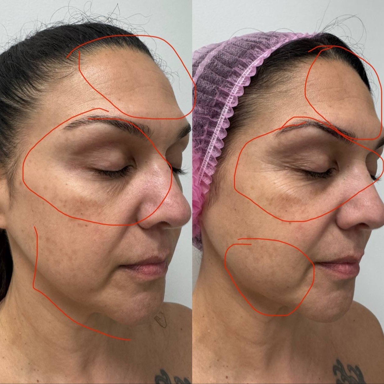 Renewal Peels Package at Healthy skin by Alvina in Highland Park, IL