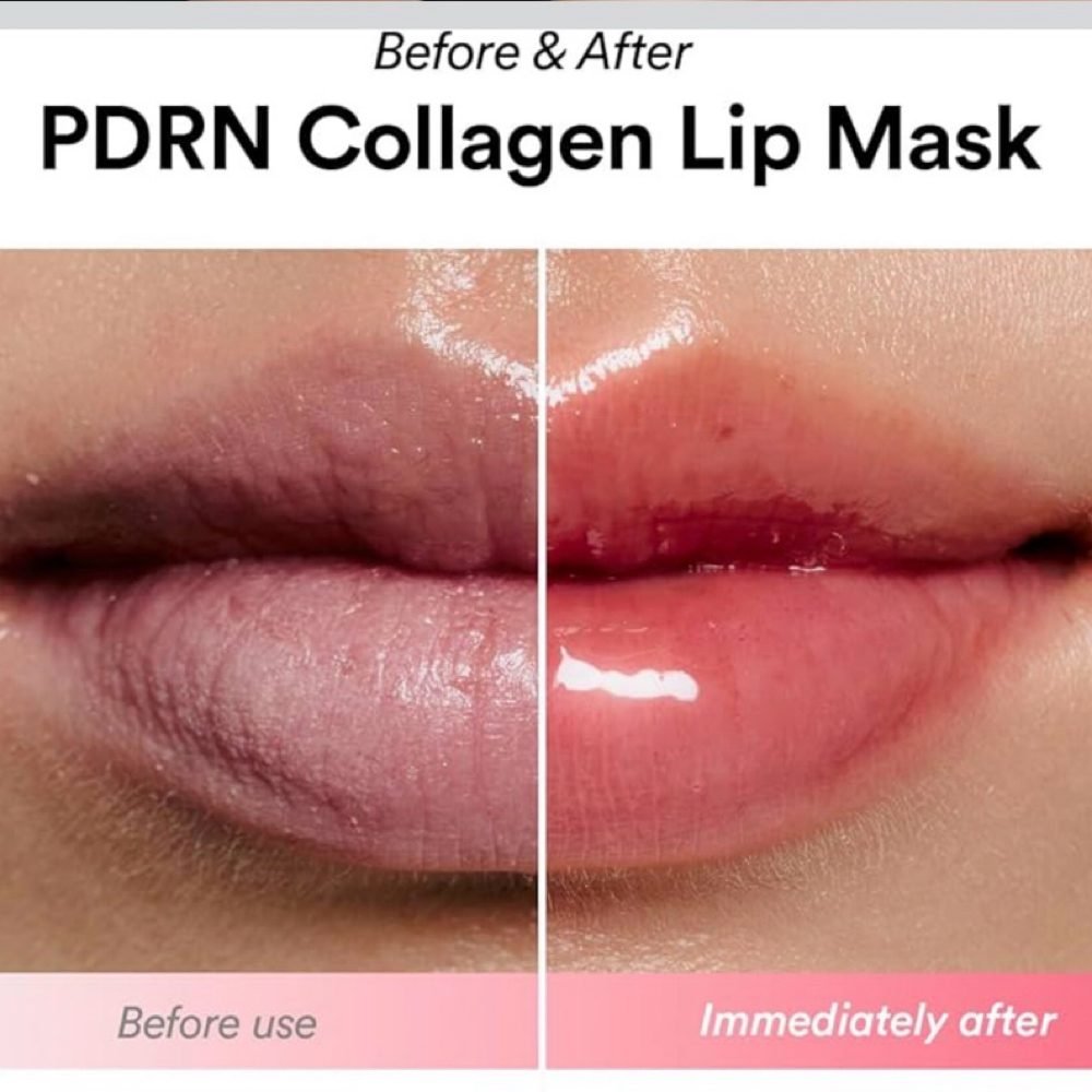 Lip Enzyme Peel + Conditioning at The Aesthetics Room in Bay View, WI