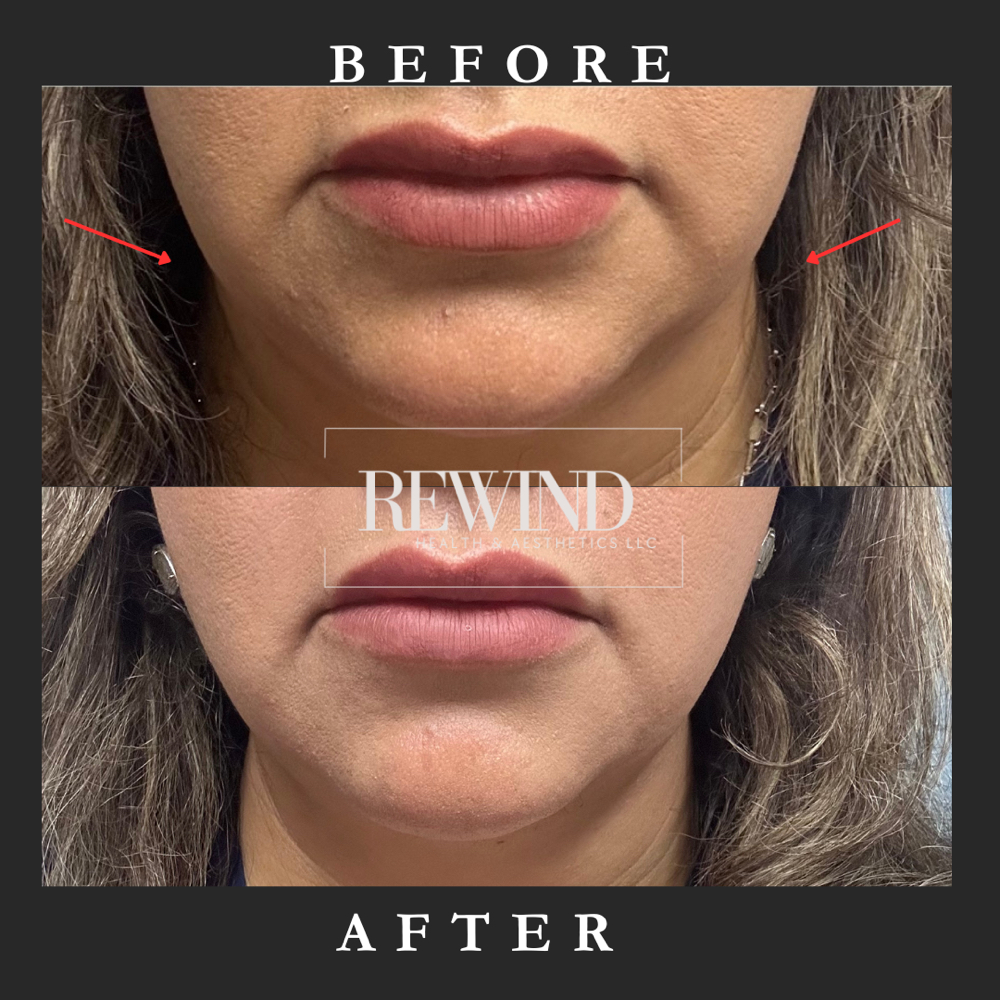 🇺🇸JULY Double Chin Treatment🇺🇸 at Rewind Health & Aesthetics LLC in San Marcos, TX