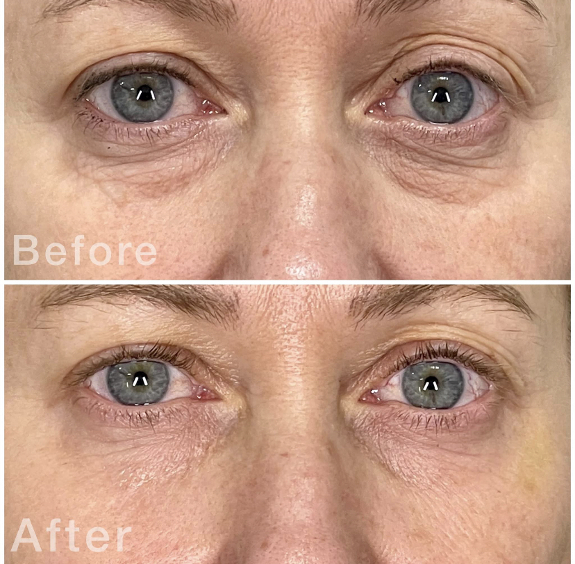 EYES SKIN TIGHTENING