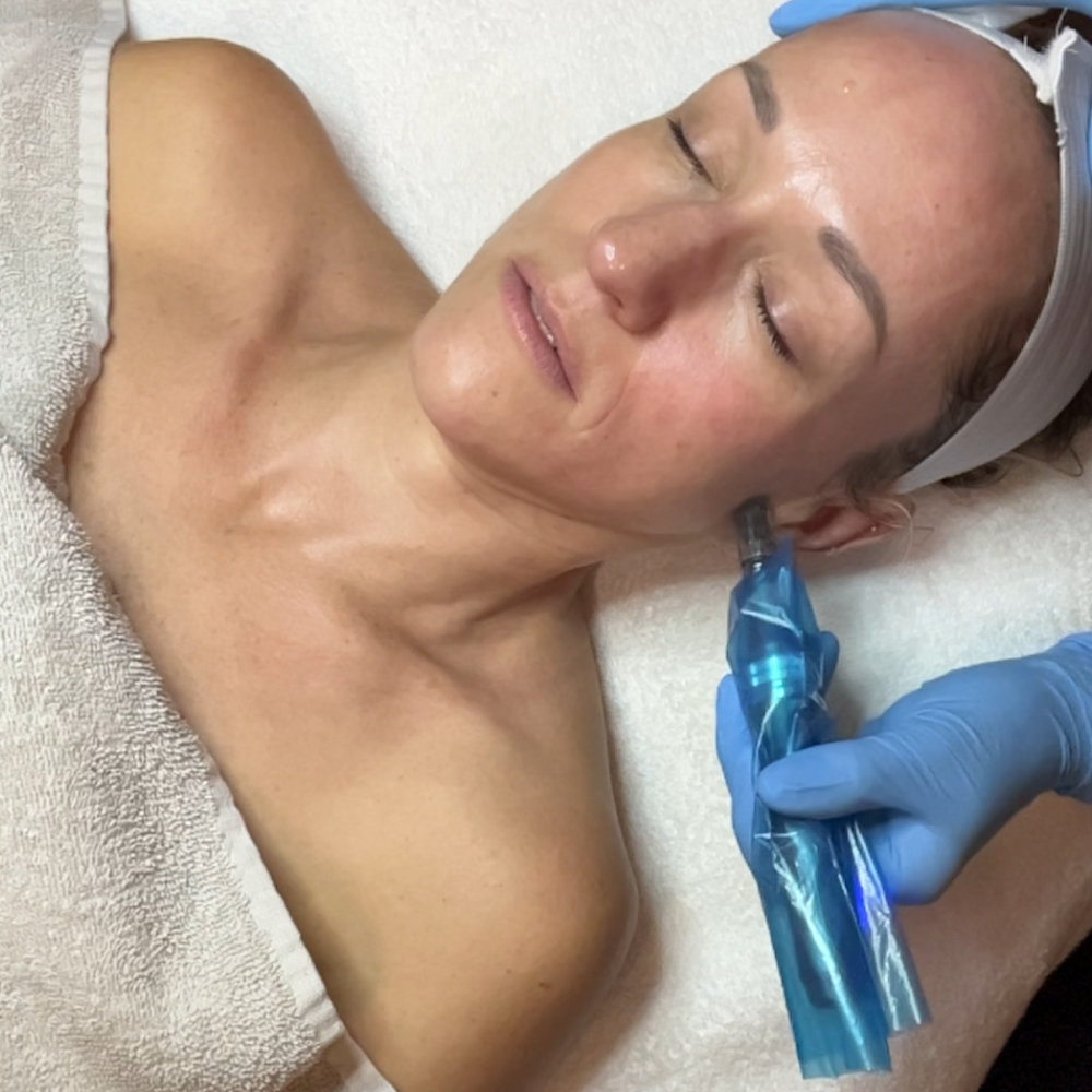 Micro-Needling *FREE RED LED PROMO