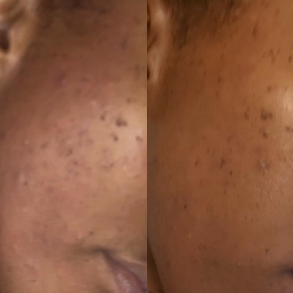 Hyperpigmentation Reset Facial at Xtreme Lush Skin in Houston, TX