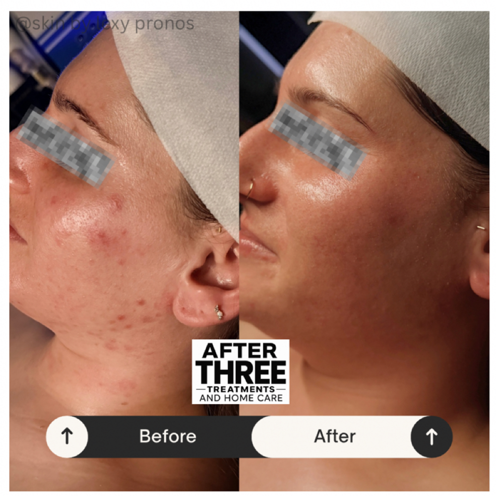 Corrective Clarifying Acne Facial at Gemini Esthetics in Naperville, IL