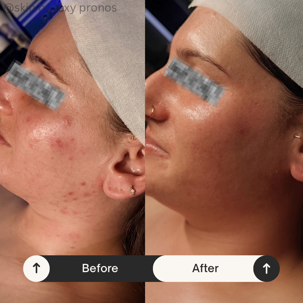 Clarifying Oxygen Acne Facial at Gemini Esthetics in Naperville, IL