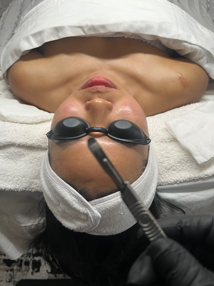 Dermaplane Add On