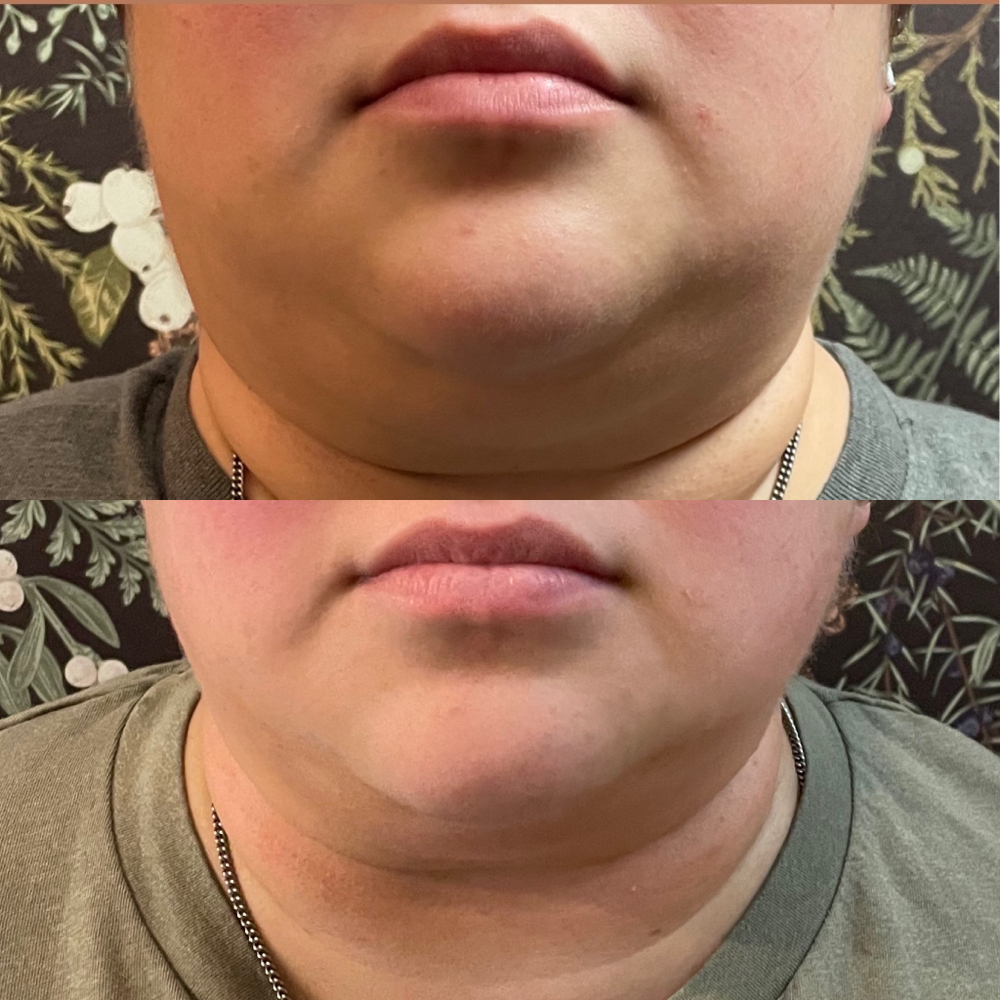 Chin Fat Dissolve
