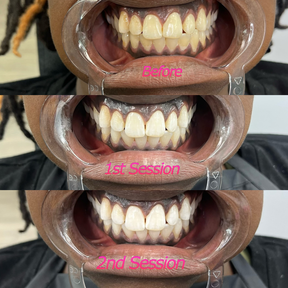 1 Session at Too Flawless Esthetics in Memphis, TN