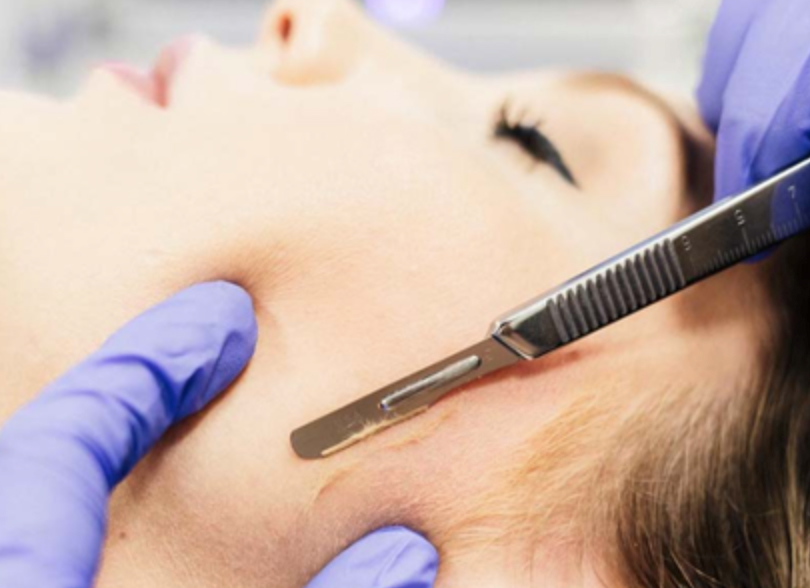 Dermaplaning