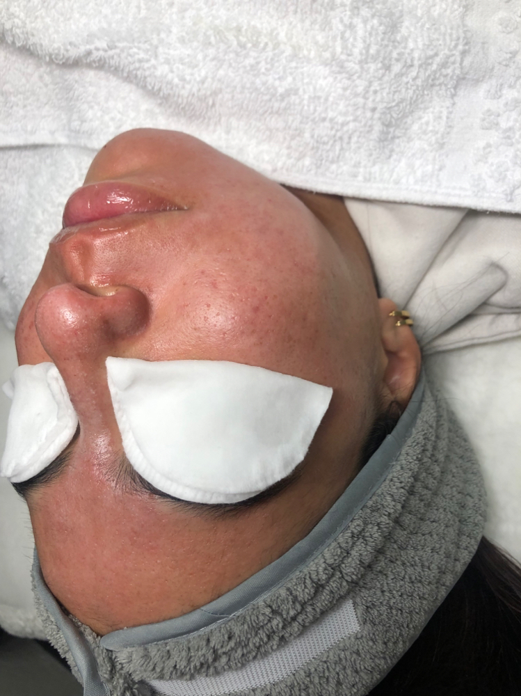 Mandiclear Chemical Peel