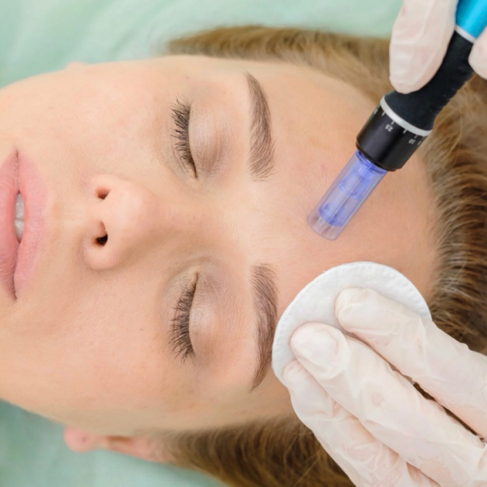 Micro-Needling at Kel Bella Aesthetics in Santa Clarita, CA